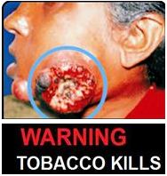 India 2013 Health Effects Mouth (Smokeless Tobacco Products) - diseased organ, gross